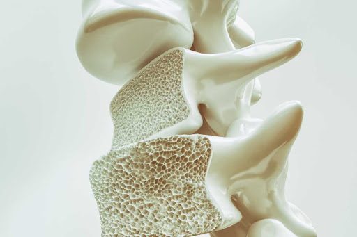 Osteoporose: Saiba o que é e como fazer o tratamento