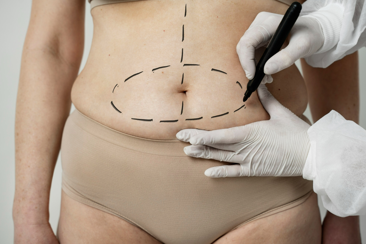 Abdominoplastia: Uma Análise Detalhada sobre o Procedimento Cirúrgico, Recuperação e Impacto na Qualidade de Vida