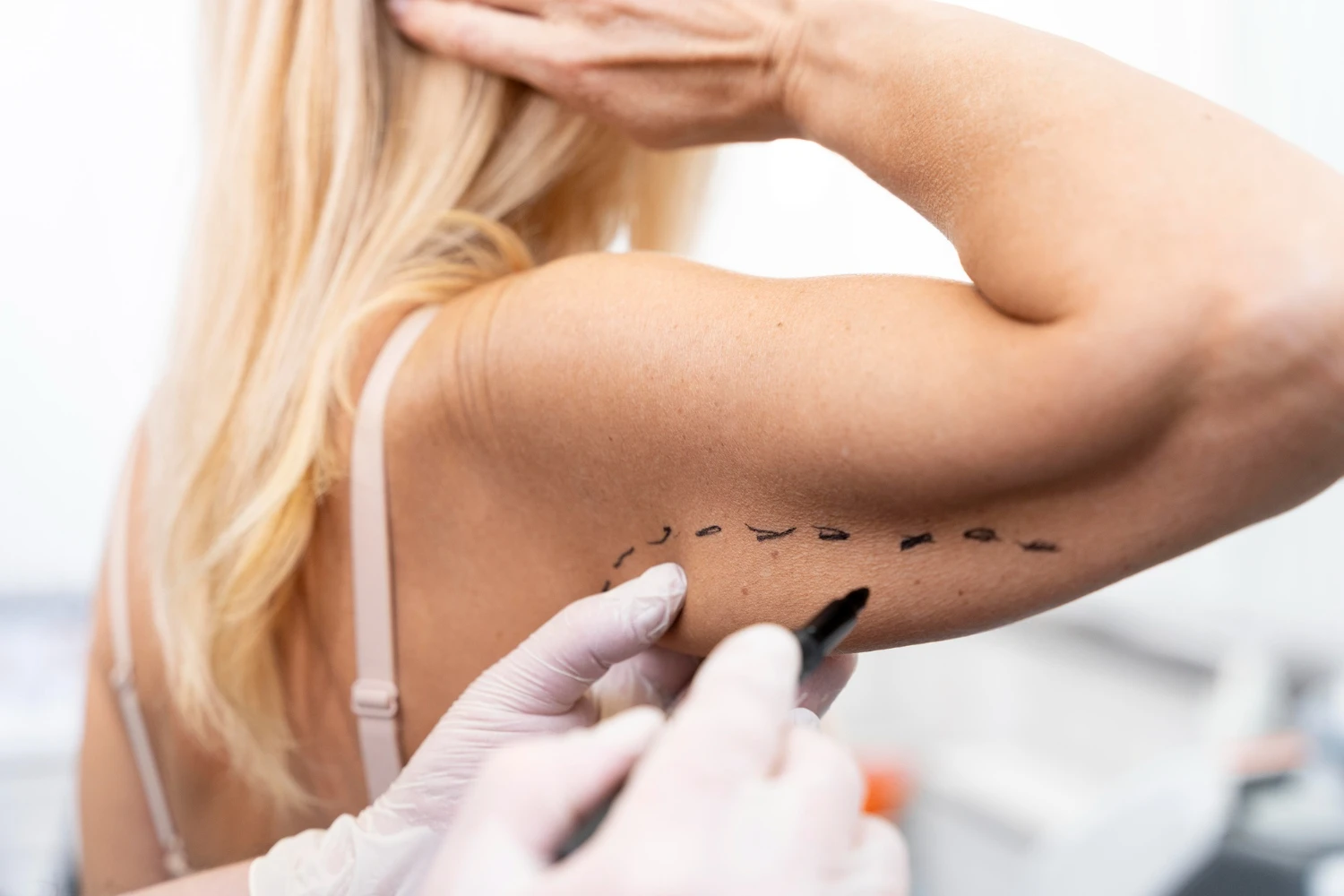 Procedimento de cirurgia plástica na vila nova conceição e pinheiros, com marcações no braço de uma paciente durante avaliação para cirurgia estética.